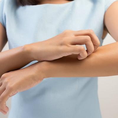 被蟲子咬瞭紅腫癢怎麼辦