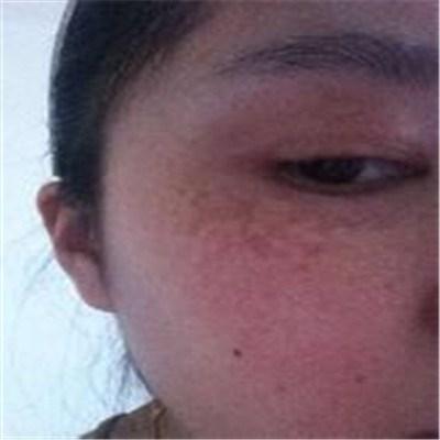 宮毒斑怎麼日常護理