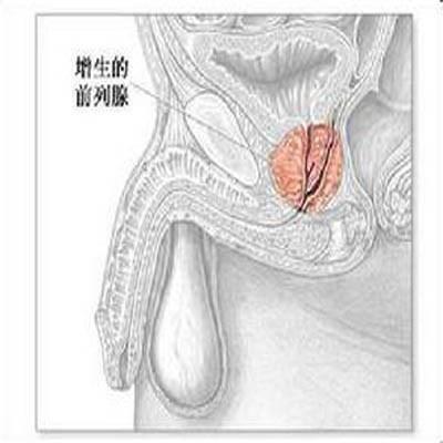 前列腺增生手術費用是多少