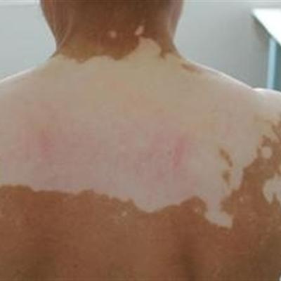 白癜風初期的癥狀有什麼