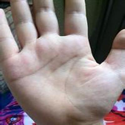 右手第五掌骨骨折怎麼辦