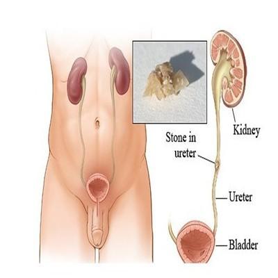 腎結石堵住輸尿管怎麼辦