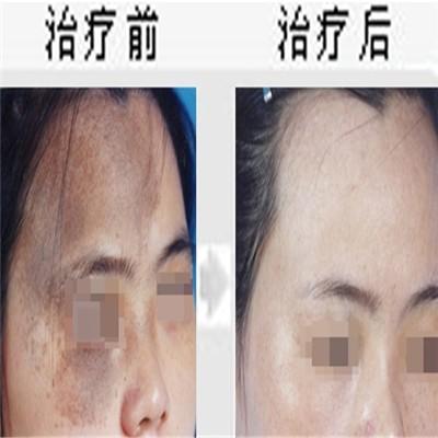 點痣的最好方法