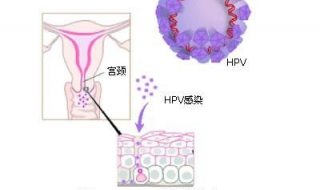 HPV是什麼 隻有瞭解其病因才能及早的預防