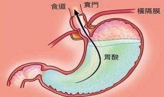 胃酸怎麼辦 緩解胃酸的三個方法