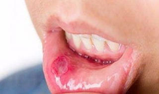 口腔潰瘍怎麼辦 4種方法治療口腔潰瘍