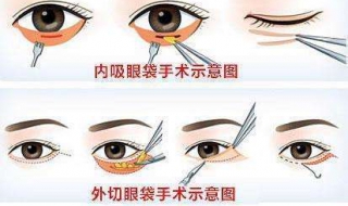 去眼袋最有效的方法 5個方法去眼袋