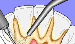 牙結石怎麼去除 如何預防牙結石