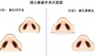 縮小鼻翼的方法 六個縮小方法