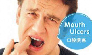 口腔潰瘍怎麼辦 五個治療和預防方法