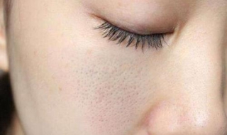 皮膚毛孔變大怎麼辦 如何改善毛孔粗大