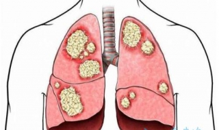 鱗癌和腺癌的區別 這四個區別你知道哪個