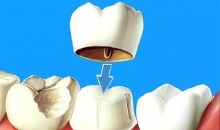補牙後註意事項 補牙後需要註意哪些