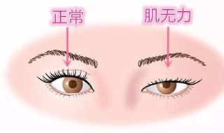 上眼瞼下垂怎麼辦 上瞼下垂怎麼診斷