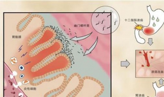 胃鏡檢查後註意事項 做完胃鏡之後有一些需要註意的事項