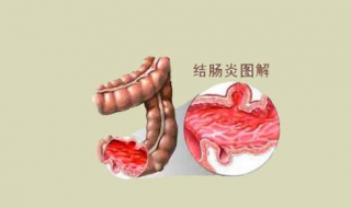 得瞭結腸炎怎麼辦 有這樣三種治療方法