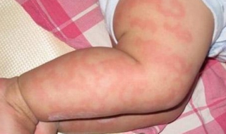 小孩皮膚過敏怎麼辦 預防措施總結如下