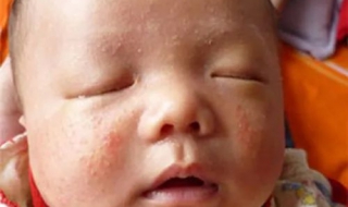寶寶長濕疹怎麼辦 註意以下幾個方面
