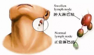 頸部淋巴結腫大怎麼辦 頸部淋巴結腫大的原因有四種