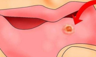 口舌生瘡怎麼辦 可以從這些方面預防