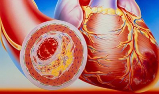 動脈硬化怎麼辦 請記住這4點有用方法
