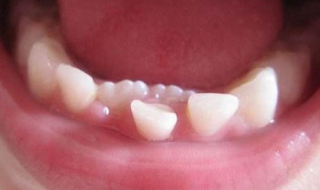 乳牙滯留怎麼辦 不同的處理方案推薦