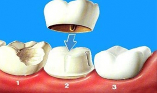 牙齒缺損怎麼辦 常見的修復方法總結