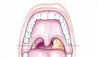 扁桃體化膿怎麼辦 三種常規治療方法分享