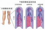 下肢深靜脈血栓形成