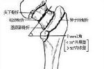 橈骨頸骨折