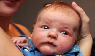 嬰兒臉上長濕疹怎麼治寶媽別擔心以下妙招緩解寶寶的肌膚問題