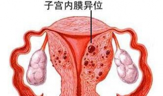 子宮內膜移位怎麼辦 兩種治療方式推薦
