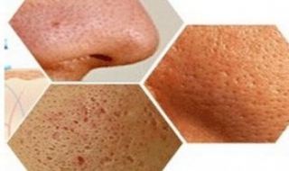 皮膚毛孔粗糙怎麼辦 有什麼方法改善？