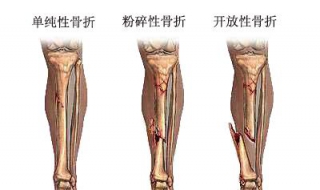 骨折病人不能吃什麼 有哪些禁忌？