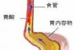 胃食管反流病