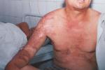 汗腺癌