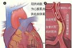 右室心肌梗死