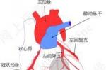 右室心肌梗死