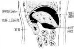 膈下膿腫