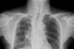 先天性肺動靜脈瘺