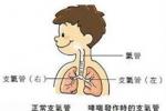 過敏性哮喘