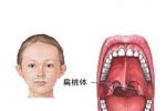 慢性扁桃體炎