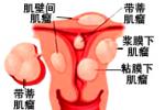 子宮頸平滑肌瘤