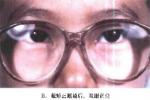 周期性內斜視