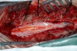小兒椎管內腫瘤
