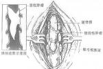 小兒椎管內腫瘤