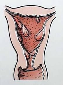 卵巢功能缺如綜合征