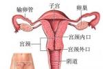 子宮內膜異位癥