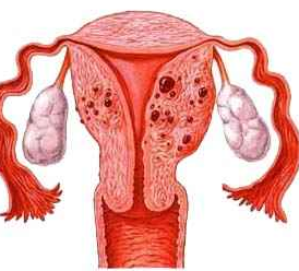 卵巢囊腫