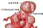 卵巢囊腫